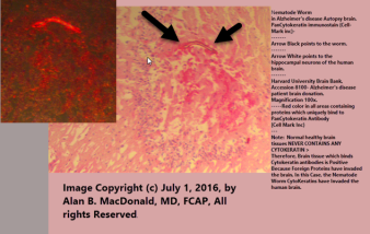 PanCytokeratin Worm positive Immunostain in alzheimer's Brain with Fluorescent Insert Image